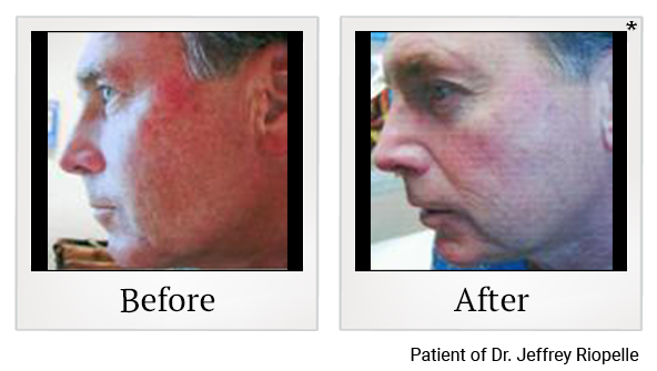 Before and After Photo 2 of Photodynamic Therapy treatment at SF Bay Cosmetic Surgery Medical Group in San Ramon