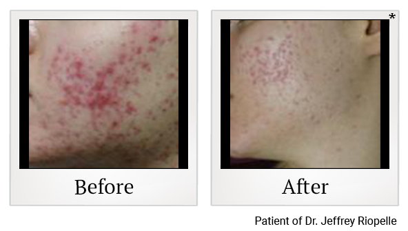 Before and After Photo 3 of Photodynamic Therapy treatment at SF Bay Cosmetic Surgery Medical Group in San Ramon