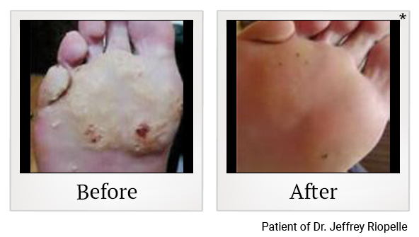 Before and After Photo 4 of Photodynamic Therapy treatment at SF Bay Cosmetic Surgery Medical Group in San Ramon