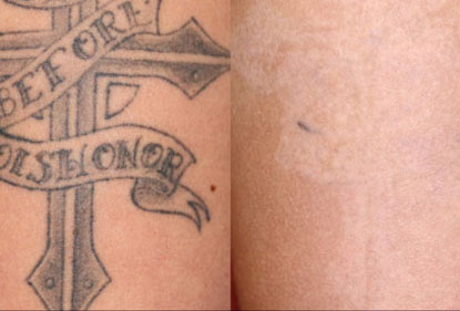 Before and After Photo 1 of Picosure Laser Tattoo Removal treatment at SF Bay Cosmetic Surgery Medical Group in San Ramon