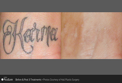 Before and After Photo 2 of Picosure Laser Tattoo Removal treatment at SF Bay Cosmetic Surgery Medical Group in San Ramon
