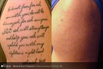 Before and After Photo 4 of Picosure Laser Tattoo Removal treatment at SF Bay Cosmetic Surgery Medical Group in San Ramon