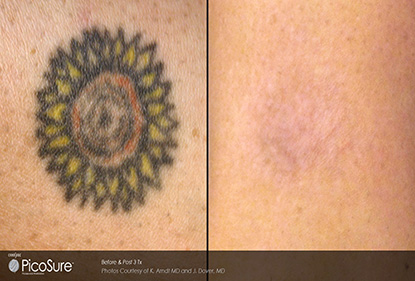 Before and After Photo 6 of Picosure Laser Tattoo Removal treatment at SF Bay Cosmetic Surgery Medical Group in San Ramon
