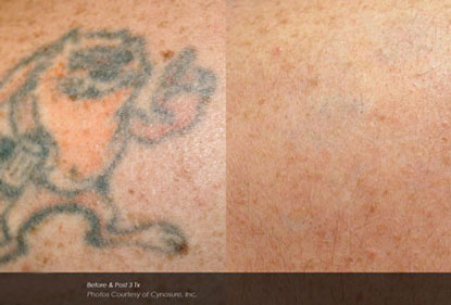 Before and After Photo 7 of Picosure Laser Tattoo Removal treatment at SF Bay Cosmetic Surgery Medical Group in San Ramon