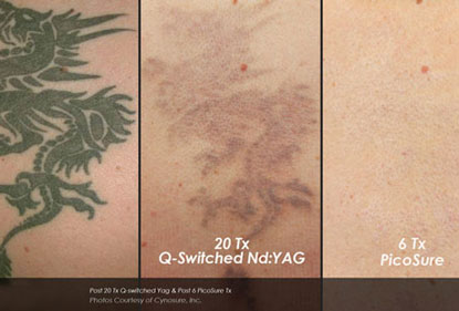 Before and After Photo 8 of Picosure Laser Tattoo Removal treatment at SF Bay Cosmetic Surgery Medical Group in San Ramon