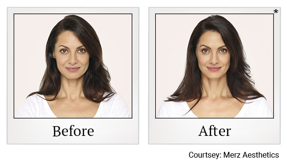 Before and After Photo 1 of Radiesse® treatment at SF Bay Cosmetic Surgery Medical Group in San Ramon