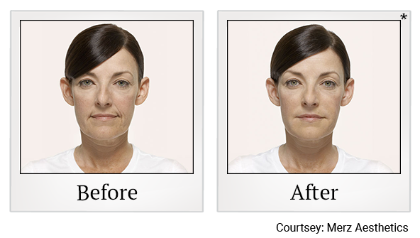 Before and After Photo 4 of Radiesse® treatment at SF Bay Cosmetic Surgery Medical Group in San Ramon