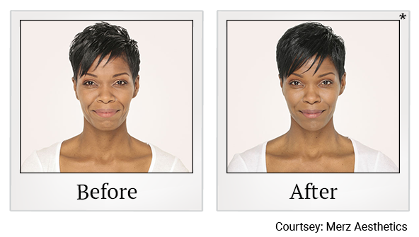 Before and After Photo 5 of Radiesse® treatment at SF Bay Cosmetic Surgery Medical Group in San Ramon