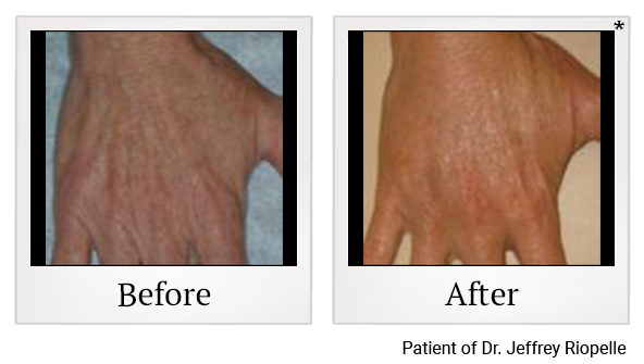 Before and After Photo 7 of Radiesse® treatment at SF Bay Cosmetic Surgery Medical Group in San Ramon