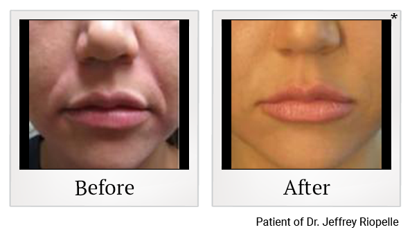 Before and After Photo 2 of Radiesse® treatment at SF Bay Cosmetic Surgery Medical Group in San Ramon, Pleasanton, San Jose, and Oakland