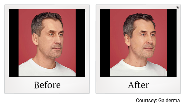 Before and After Photo 1 of Restylane® treatment at SF Bay Cosmetic Surgery Medical Group in San Ramon