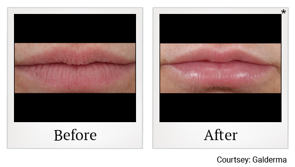 Before and After Photo 10 of Restylane® treatment at SF Bay Cosmetic Surgery Medical Group in San Ramon