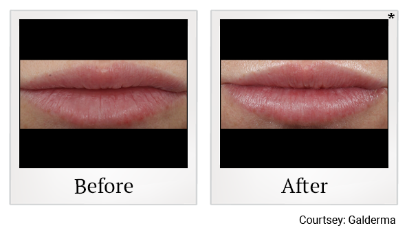 Before and After Photo 11 of Restylane® treatment at SF Bay Cosmetic Surgery Medical Group in San Ramon