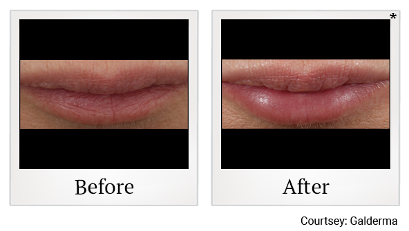 Before and After Photo 12 of Restylane® treatment at SF Bay Cosmetic Surgery Medical Group in San Ramon