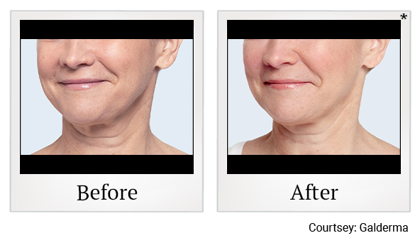 Before and After Photo 13 of Restylane® treatment at SF Bay Cosmetic Surgery Medical Group in San Ramon