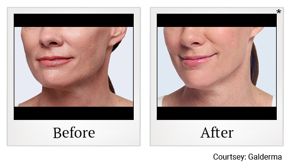 Before and After Photo 6 of Restylane® Fillers treatment at SF Bay Cosmetic Surgery Medical Group in San Ramon