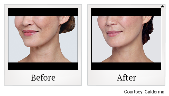 Before and After Photo 15 of Restylane® treatment at SF Bay Cosmetic Surgery Medical Group in San Ramon