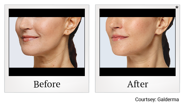 Before and After Photo 16 of Restylane® treatment at SF Bay Cosmetic Surgery Medical Group in San Ramon