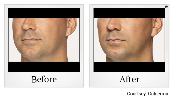 Before and After Photo 17 of Restylane® treatment at SF Bay Cosmetic Surgery Medical Group in San Ramon