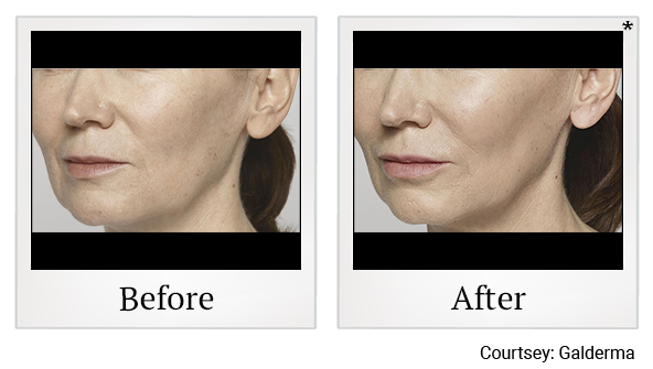 Before and After Photo 18 of Restylane® treatment at SF Bay Cosmetic Surgery Medical Group in San Ramon