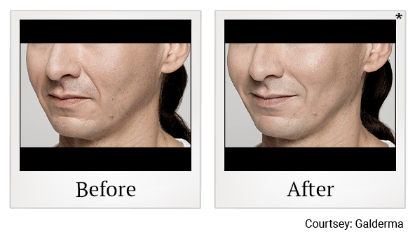 Before and After Photo 19 of Restylane® treatment at SF Bay Cosmetic Surgery Medical Group in San Ramon