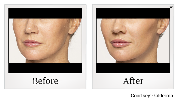 Before and After Photo 20 of Restylane® treatment at SF Bay Cosmetic Surgery Medical Group in San Ramon