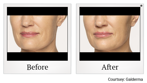 Before and After Photo 21 of Restylane® treatment at SF Bay Cosmetic Surgery Medical Group in San Ramon