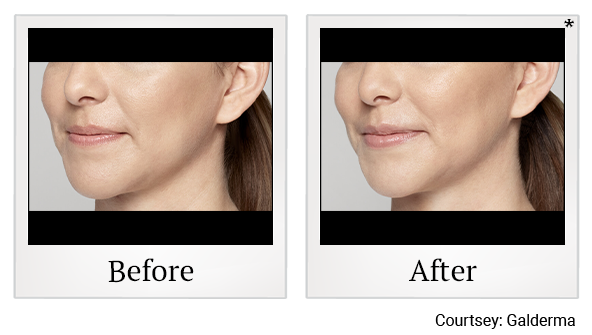 Before and After Photo 22 of Restylane® treatment at SF Bay Cosmetic Surgery Medical Group in San Ramon