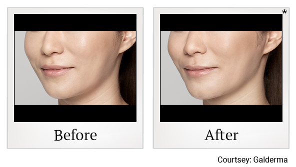 Before and After Photo 23 of Restylane® treatment at SF Bay Cosmetic Surgery Medical Group in San Ramon