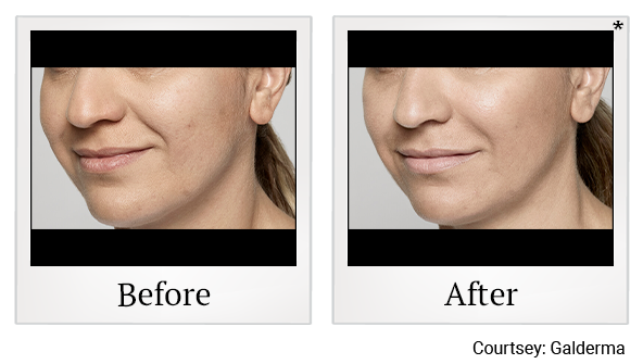 Before and After Photo 24 of Restylane® treatment at SF Bay Cosmetic Surgery Medical Group in San Ramon
