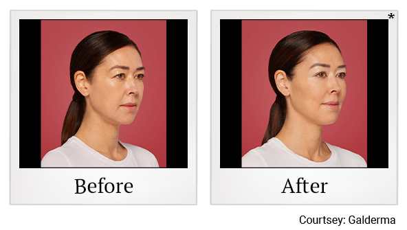 Before and After Photo 3 of Restylane® treatment at SF Bay Cosmetic Surgery Medical Group in San Ramon