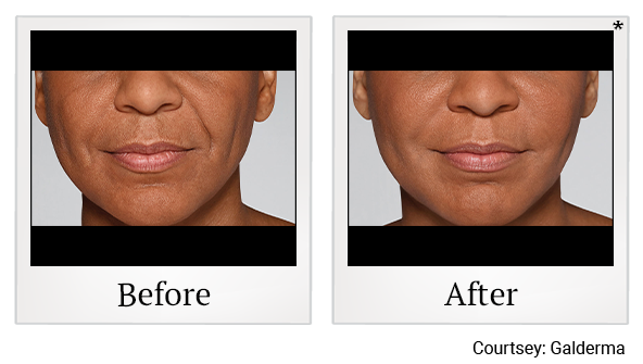 Before and After Photo 35 of Restylane® treatment at SF Bay Cosmetic Surgery Medical Group in San Ramon
