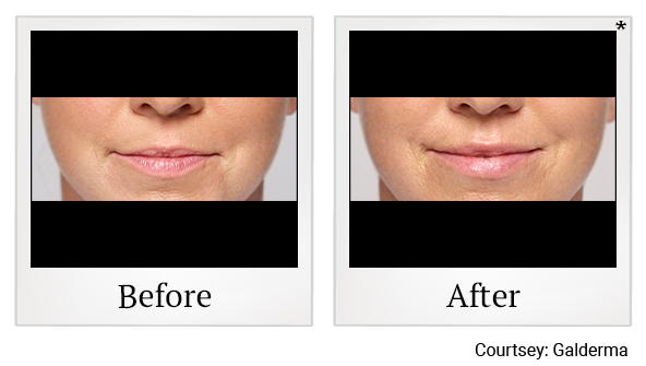 Before and After Photo 36 of Restylane® treatment at SF Bay Cosmetic Surgery Medical Group in San Ramon