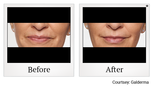 Before and After Photo 38 of Restylane® treatment at SF Bay Cosmetic Surgery Medical Group in San Ramon