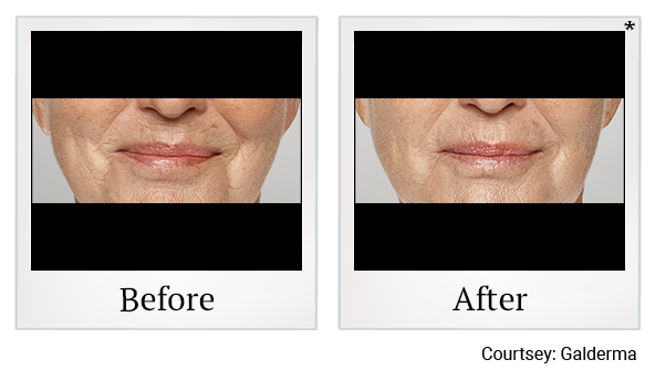 Before and After Photo 39 of Restylane® treatment at SF Bay Cosmetic Surgery Medical Group in San Ramon