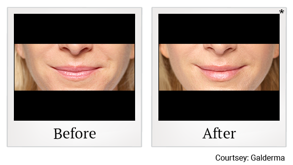 Before and After Photo 41 of Restylane® treatment at SF Bay Cosmetic Surgery Medical Group in San Ramon