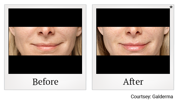 Before and After Photo 42 of Restylane® treatment at SF Bay Cosmetic Surgery Medical Group in San Ramon