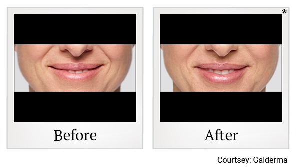 Before and After Photo 43 of Restylane® treatment at SF Bay Cosmetic Surgery Medical Group in San Ramon