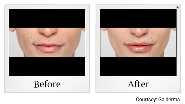 Before and After Photo 44 of Restylane® treatment at SF Bay Cosmetic Surgery Medical Group in San Ramon
