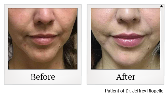 Before and After Photo 45 of Restylane® treatment at SF Bay Cosmetic Surgery Medical Group in San Ramon