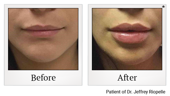 Before and After Photo 46 of Restylane® treatment at SF Bay Cosmetic Surgery Medical Group in San Ramon