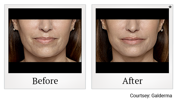 Before and After Photo 3 of Restylane® Fillers treatment at SF Bay Cosmetic Surgery Medical Group in San Ramon