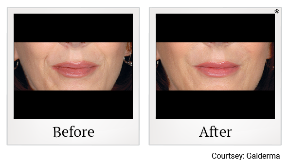 Before and After Photo 52 of Restylane® treatment at SF Bay Cosmetic Surgery Medical Group in San Ramon