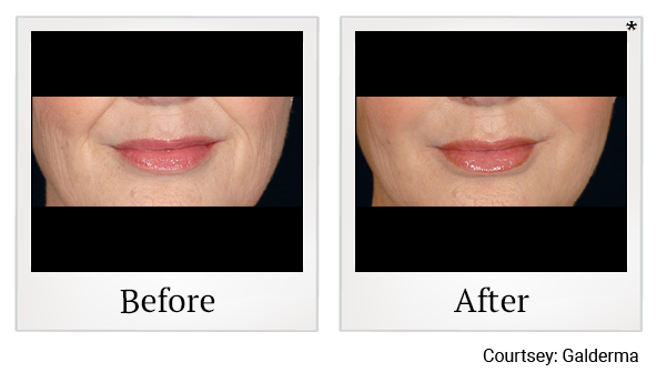 Before and After Photo 53 of Restylane® treatment at SF Bay Cosmetic Surgery Medical Group in San Ramon