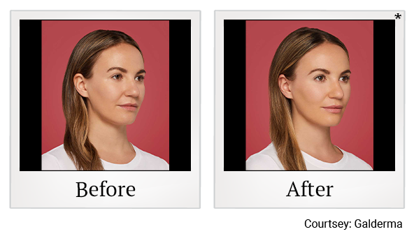 Before and After Photo 6 of Restylane® treatment at SF Bay Cosmetic Surgery Medical Group in San Ramon