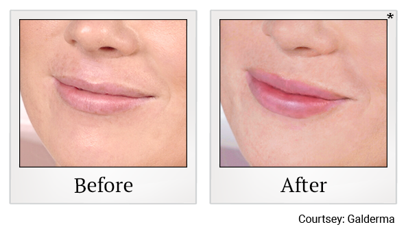 Before and After Photo 8 of Restylane® treatment at SF Bay Cosmetic Surgery Medical Group in San Ramon