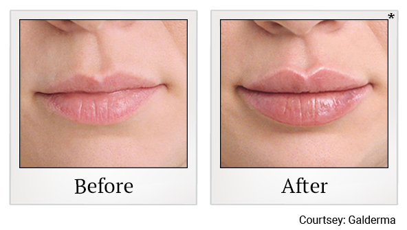 Before and After Photo 9 of Restylane® treatment at SF Bay Cosmetic Surgery Medical Group in San Ramon