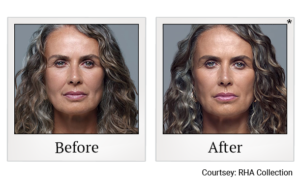 Before and After Photo 2 of RHA® Collection treatment at SF Bay Cosmetic Surgery Medical Group in San Ramon