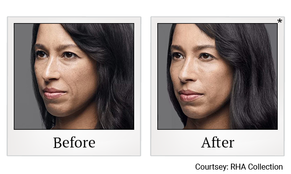 Before and After Photo 3 of RHA® Collection Fillers treatment at SF Bay Cosmetic Surgery Medical Group in San Ramon