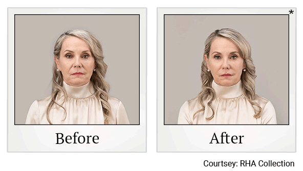 Before and After Photo 5 of RHA® Collection Fillers treatment at SF Bay Cosmetic Surgery Medical Group in San Ramon, Pleasanton, San Jose, and Oakland